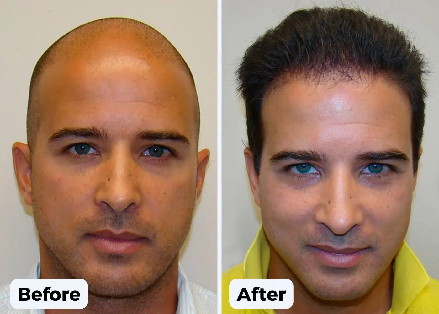 Regain your Hairline and Forge Fuller, Thicker, Stronger hair in just 2 weeks! Luxiz™️