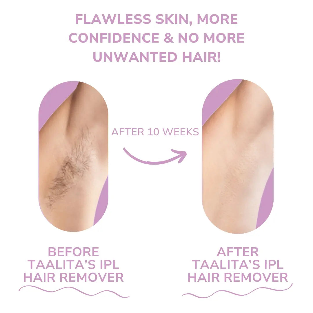 Luxiz™ IPL Hair Remover I The leading laser hair removal for your home Phoera™️