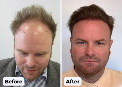 Regain your Hairline  and Forge Fuller, Thicker, Stronger hair  in just 2 weeks! Luxiz™️