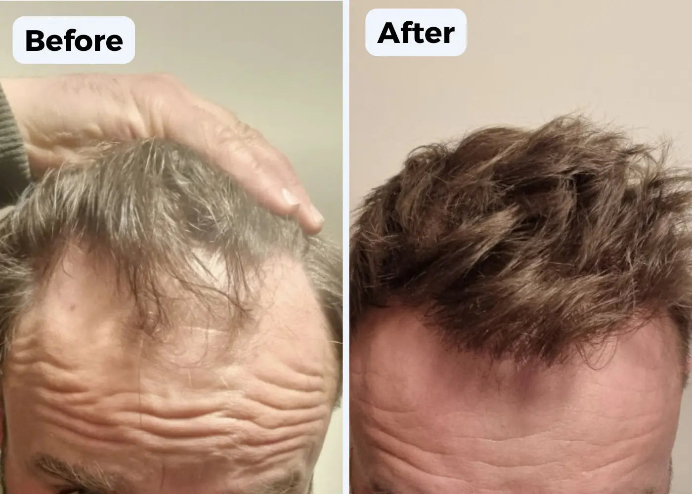 Regain your Hairline  and Forge Fuller, Thicker, Stronger hair  in just 2 weeks! Luxiz™️