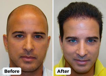 Regain your Hairline  and Forge Fuller, Thicker, Stronger hair  in just 2 weeks! Luxiz™️